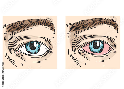 conjunctivitis eyes look pink eye ill sick bactery virus face illustration line drawing on white background