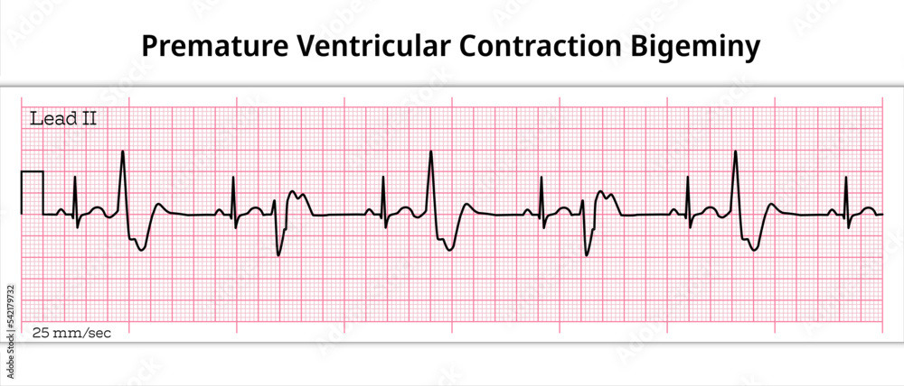Premature Ventricular Contraction Ecg