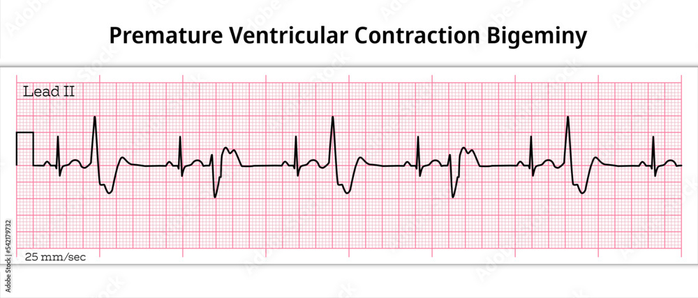 Vetor De ECG Premature Ventricular Contraction Bigeminy 8 Second ECG vetor-de-ecg-premature-ventricular-contraction-bigeminy-8-second-ecg