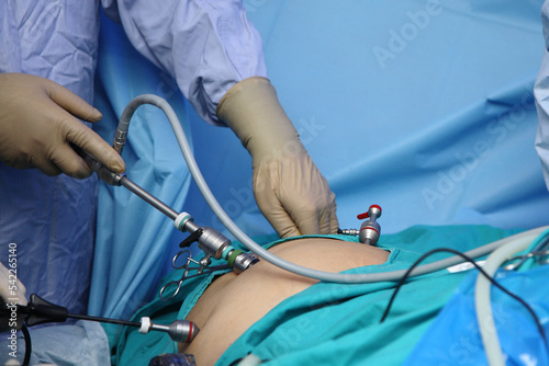 The surgeon s holing the instrument in abdomen of patient. The surgeon s doing laparoscopic surgery in the operating room. Minimally invasive surgery.