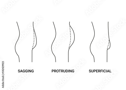 Types bellies of human body, big belly with overweight, line side view. Sagging, protruding and superficial tummy. Loss weight, reduce volume belly, surgery plastic operation. Vector illustration