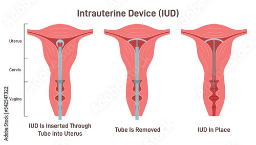 Intrauterine device. IUD placement in uterus. Female contraception