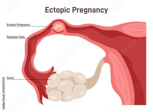 Ectopic pregnancy. Tubal pregnancy medical illustration, embryo photo