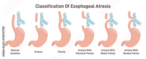 Esophageal atresia types set. Congenital medical condition of trachea photo