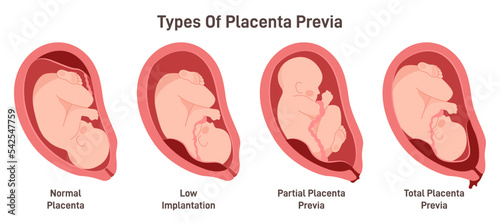Different placental locations during pregnancy. Placenta previa photo