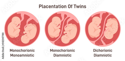 Twin types. Monozygotic or dizygotic placentation of twins, monochorionic photo