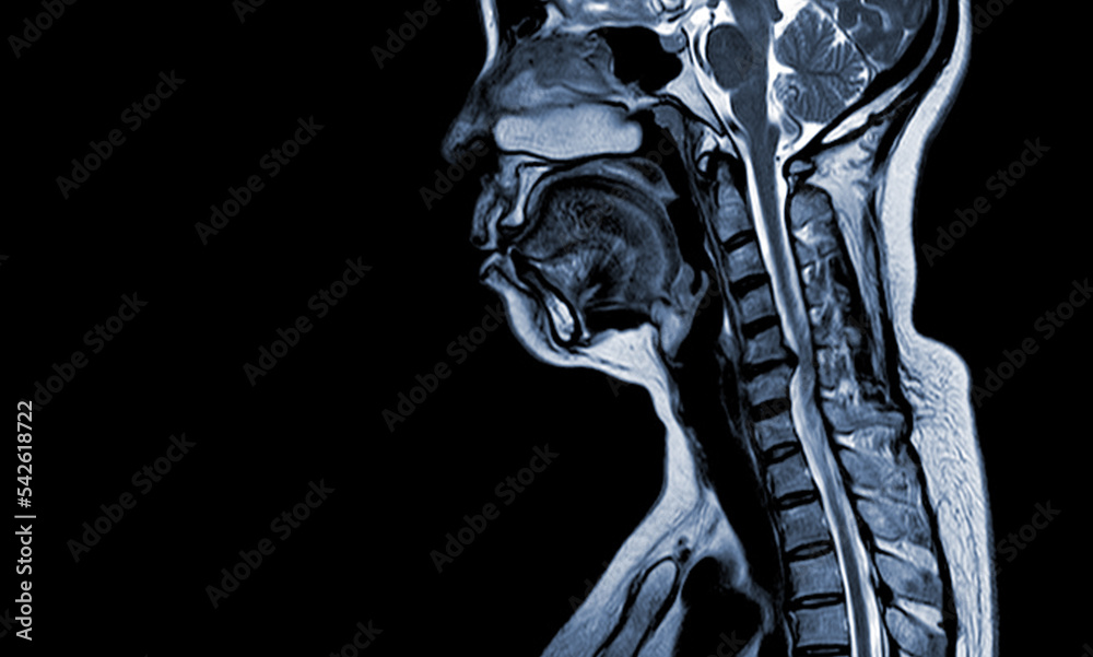 Compressed Spine Mri