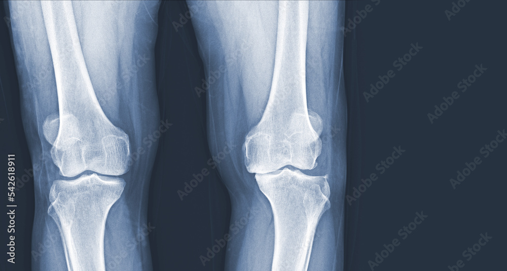 Film x-ray of human knee Osteoarthritis of the Knee normal ligaments Medical image concept.