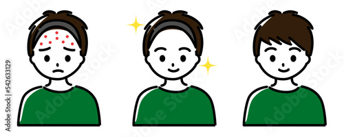 ニキビに悩む小学生から中学生くらいの男の子、ニキビが治って喜んでいる男の子のセット