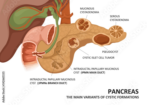 Pancreatic cyst. Main variants of cystic formations (cystadenoma ,pseudocyst etc.)