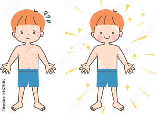 肌荒れに悩む男の子のビフォーアフター_ベクターイラスト素材