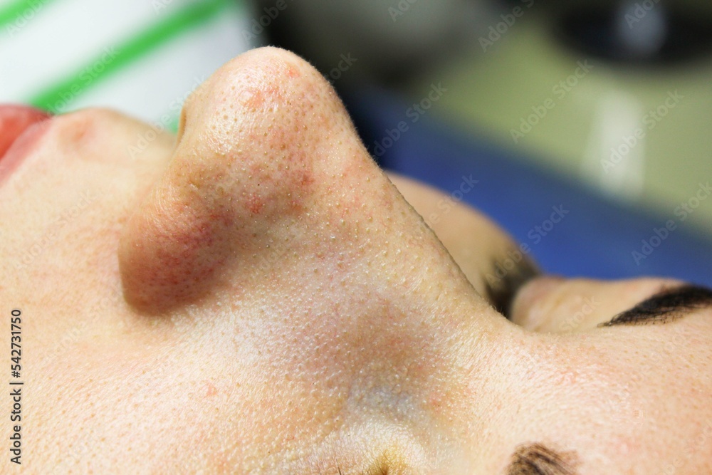 Naklejka premium cosmetology. facial skin pollution disappears. clogged sebaceous glands on the face. preparation for cleaning the skin at the beautician. facial pores, facial acne, acne treatment and comedone.