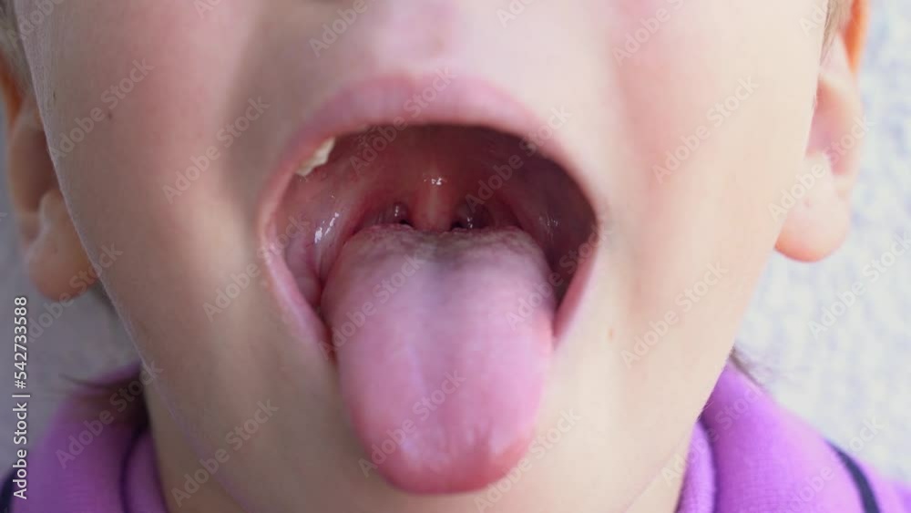 Preschool child widely open mouth showing a tongue stuck out as far as possible, with a clear view on the uvula and the soft palate. Epiglottis and the consistency of saliva are visible.