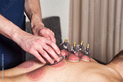 Doctor with cups for patient; therapy. Medical cupping therapy on human body; Close-up multiple vacuum cups in hands. Wellness; health injury rehabilitation concept. Alternative medicine. Copy space