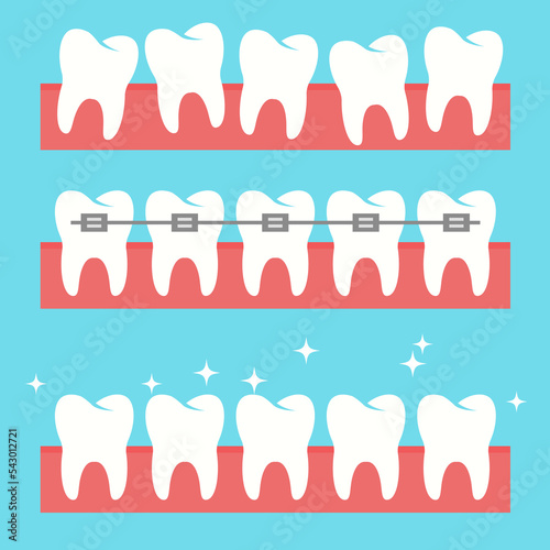 vector healthy teeth. orthodontic tooth brace
