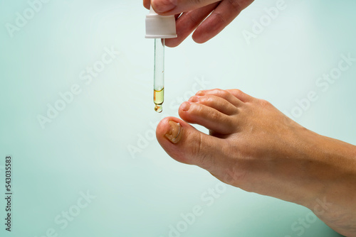 Application of oil from the pipette to a fungus-damaged nail strengthened with titanium thread photo