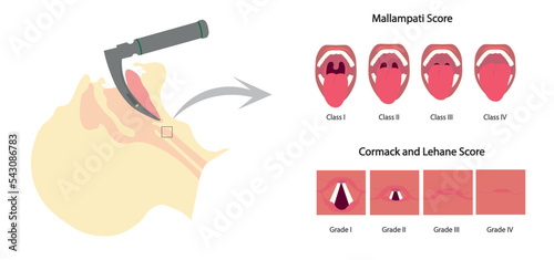 Airway managment illustration.Intubation with laryngoscopy. Mallampati and Comark lehane score assesment of airway difficult for intubation.
