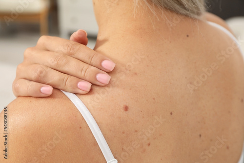 Closeup view of woman`s body with birthmarks indoors photo