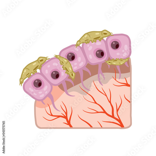 Subcutaneous tick. Skin parasite. Beetles on human epidermis.