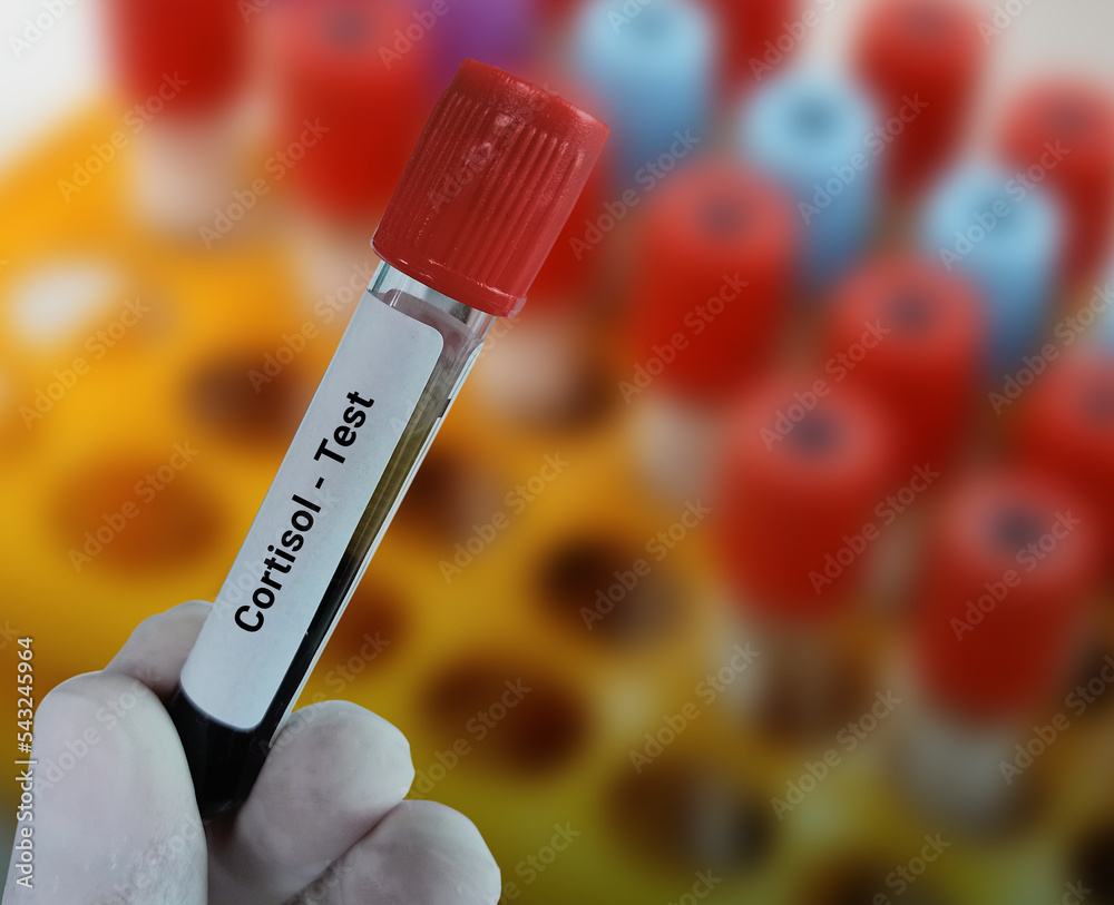 Cortisol Blood Test —