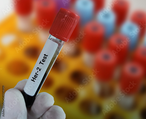 Lab Technologist holds blood sample for Her-2 receptor test, diagnosis of breast cancer with laboratory background.