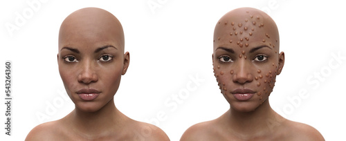 Patient with monkeypox and healthy person, 3D illustration photo