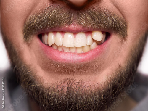 The guy has crooked teeth with a canine