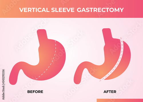 Laparoscopic Sleeve Gastrectomy, Vertical Gastrectomy, Weight loss surgery Vector Illustration of Stomach reduction surgery
