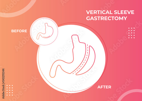 Laparoscopic Sleeve Gastrectomy, Vertical Gastrectomy, Weight loss surgery Vector Illustration of Stomach reduction surgery
