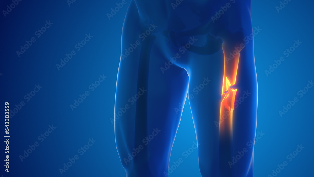 Broken leg Femur bone pain medical concept Stock Illustration | Adobe Stock