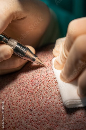 Close up of hair surgeon hands extracting follicles with a circular scalpel called a punch. photo