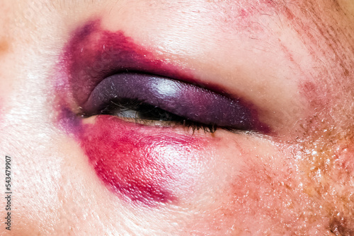 Woman with colorful Black Eye. Shiner. photo