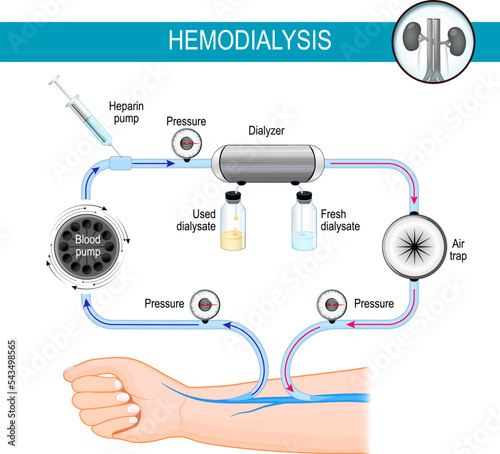 Hemodialysis machine. Dialysis process.