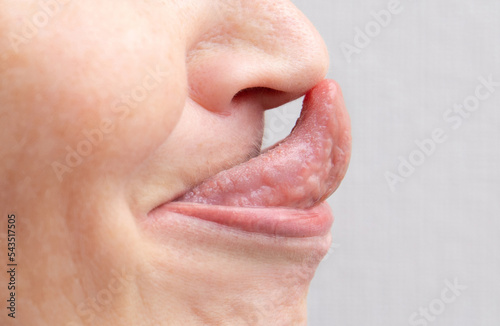 The Gorlin sign is a medical term that indicates the ability to touch the tip of the nose with the tongue. Might be the sign of Ehlers–Danlos syndrome. photo