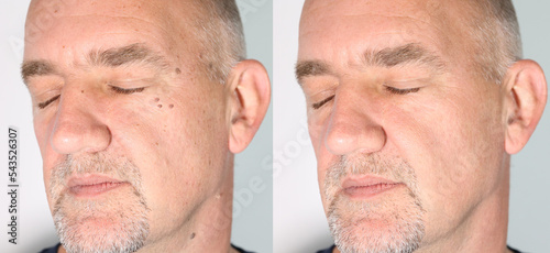 Comparison before and after skin laser treatment black spot on human. Melanoma is a type of skin cancer develops on human skin from the pigment-producing cells melanocytes. Risk to be skin cancer.