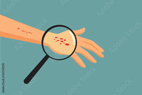 Person Suffering a Rash on His Hand Vector Medical Concept Illustration. Hand with red dots symptom of skin condition 
