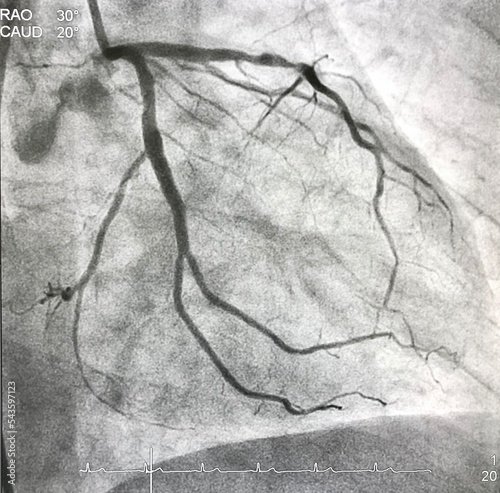 Coronary angiogram (CAG) of left coronary artery (LCA).