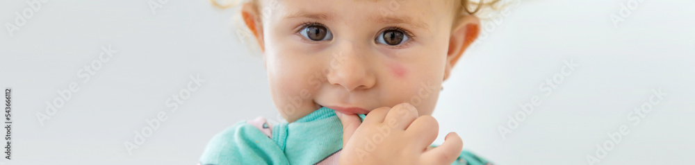 The child was bitten on the face by a mosquito. Selective focus. The child was bitten on the face by a mosquito. Selective focus.