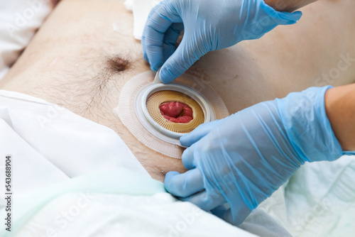 Close up stoma and colostomy after colon cancer surgery out.Cover stoma with one piece colostomy bag sticking - stoma patient care  photo