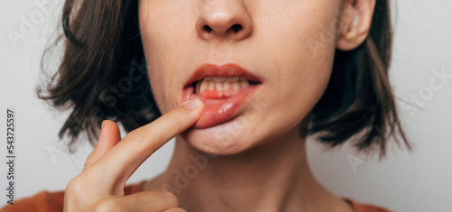 Close up shot of gum inflammation. Cropped shot of a young woman showing red bleeding gums isolated on a gray background. Dentistry, dental care photo