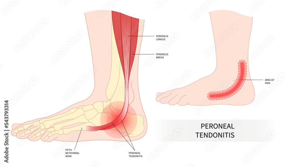 swollen trauma foot bone injury peroneal tendonitis painful ankle torn