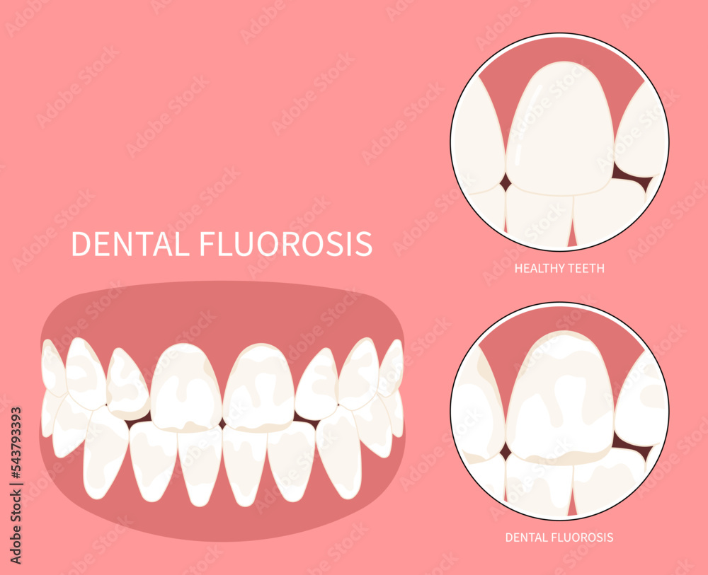 Teeth discolored in Dental with Fluorosis pitted of grooved Turner's hypoplasia Stock Vector