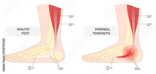 foot peroneal tendonitis painful ankle torn tendon swollen trauma side sport fall injury fifth metatarsal flat feet heel motion calf gout high arches weakness stress leg bone photo