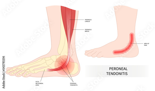 swollen trauma foot bone injury peroneal tendonitis painful ankle torn tendon side sport fall fifth metatarsal flat feet heel motion calf gout high arches weakness stress leg