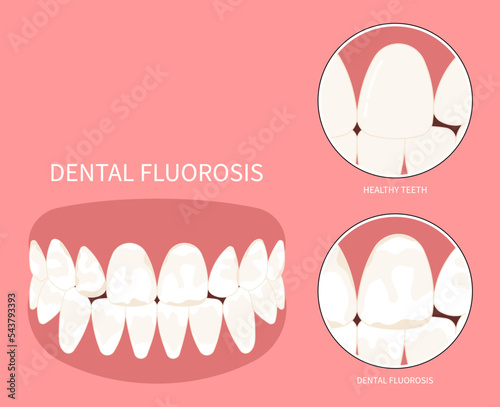 Teeth discolored in Dental with Fluorosis pitted of grooved Turner's hypoplasia