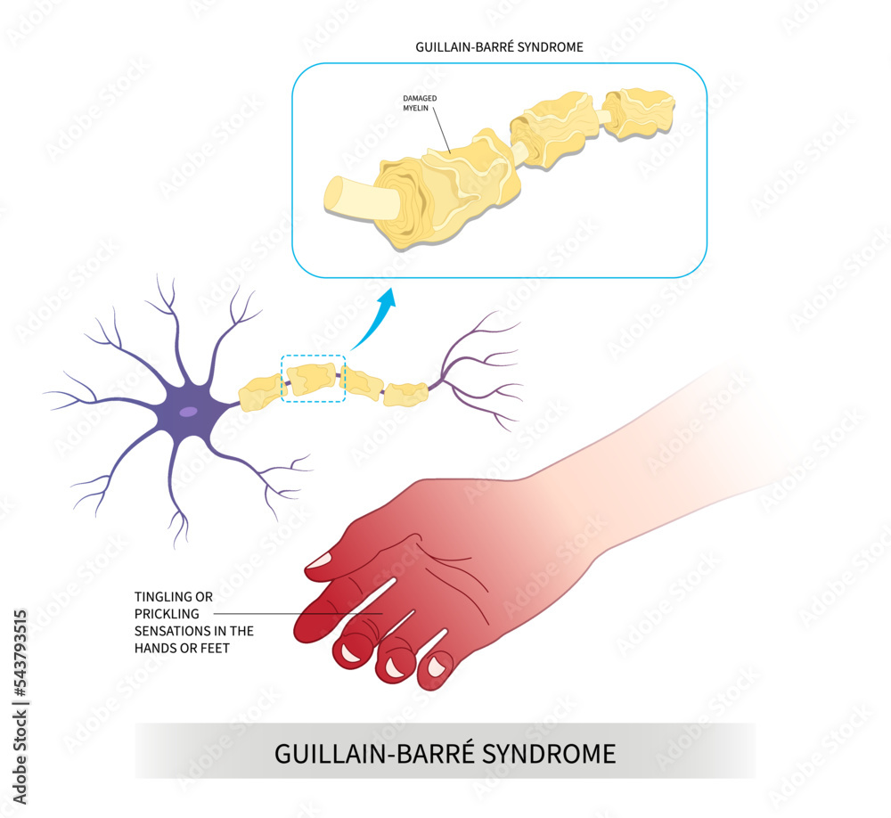 Hand numbness tingling disease Bell's palsy dysfunction Guillain Barré ...