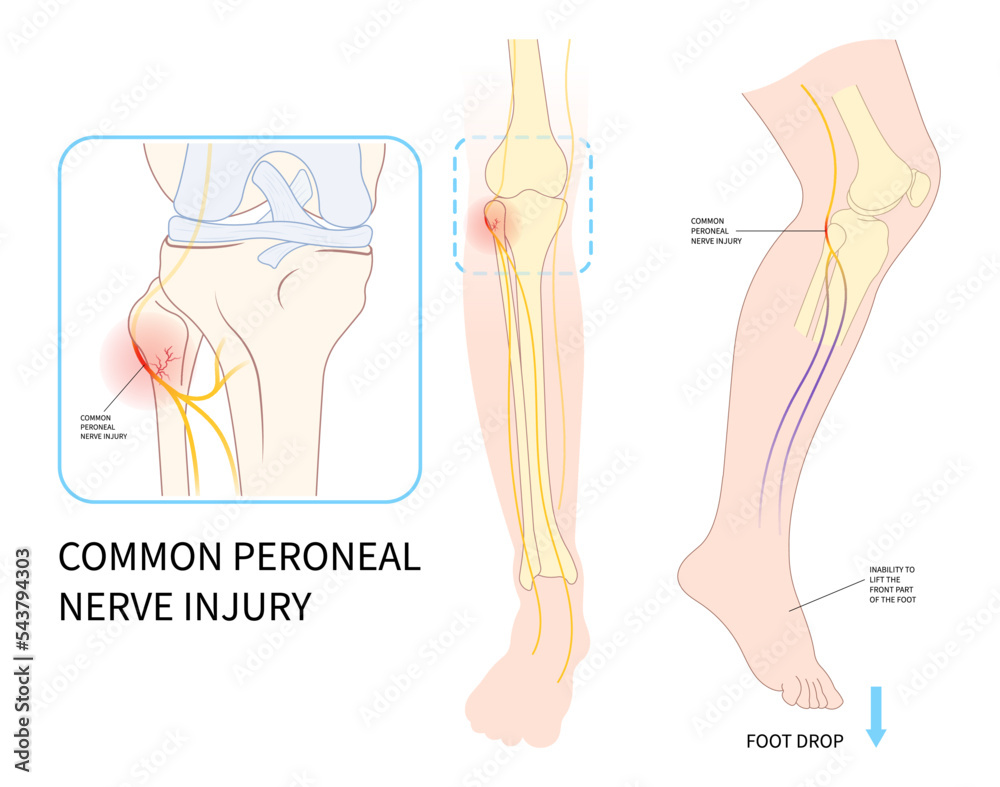 Plakat feet drop palsy leg injury and ankle pain Trauma spine lower
