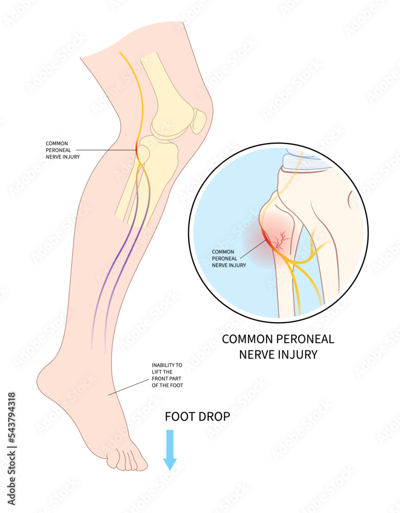 knee leg sciatic nerve injury of feet drop palsy and ankle trauma