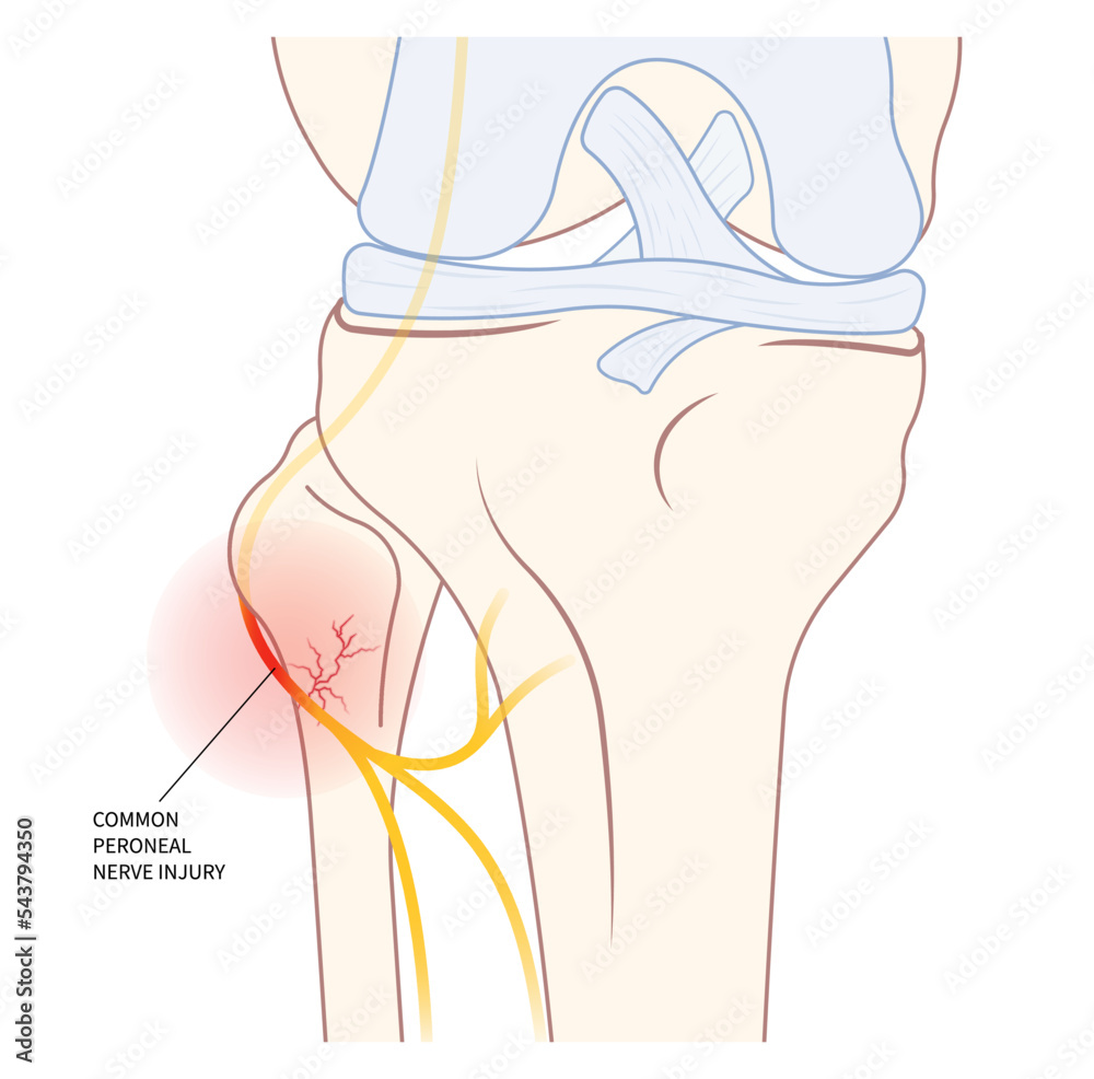 lower leg atrophy with muscle lift loss knee sciatic nerve injury of