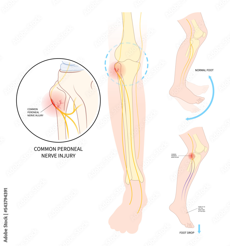lower leg atrophy with muscle lift loss knee sciatic nerve injury of feet drop palsy and spinal cord test ankle trauma tibial fibular pain spine damage brain Stroke flex deep Neck bone common cervical